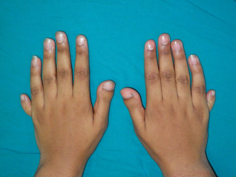 Congenital hand anomalies in Upper Egypt